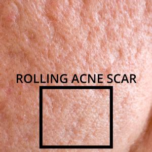 Types of Acne Scars | Rolling Scars, Box Scars, Tethered Scars NJ