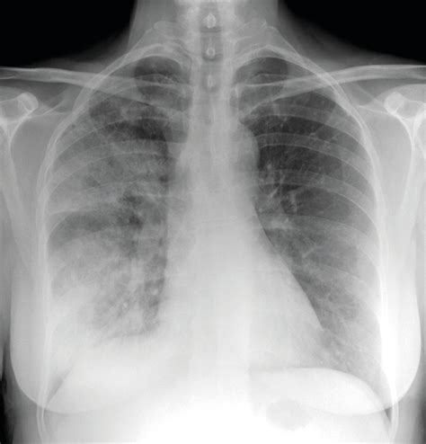 Bronchopneumonia Chest X Ray