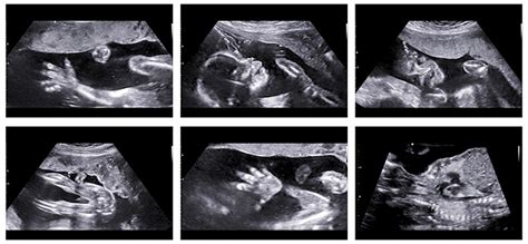 What Is Anomaly Scan During Pregnancy And Why Is It Done