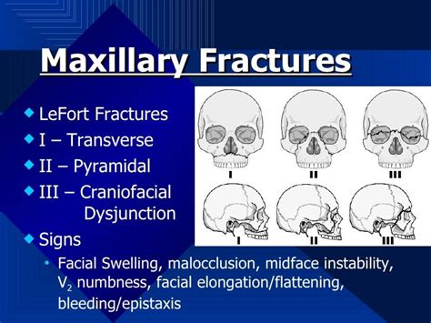 Maxillary Facial Fracture