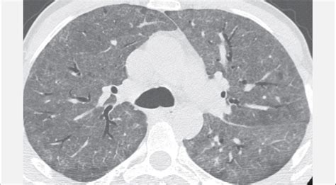 Dr Khaled Ahmed Abuzeid on Twitter: "Ground glass opacities (GGO) are increased lung density not ...