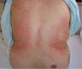 Thrombocytopenia Causes, Symptoms, Diagnosis and Treatment - Natural ...