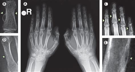 Hyperparathyroidism shows its hand: findings of osteitis fibrosa cystica - The Lancet