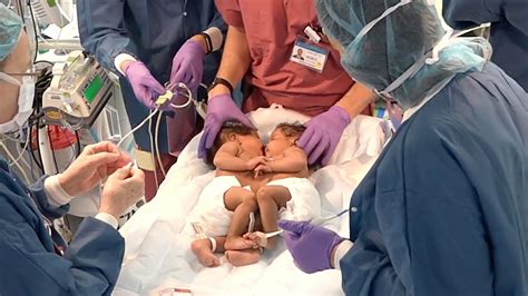 Inside the Successful Separation Surgery of Conjoined Twins | Columbia University Irving Medical ...