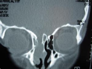 Cerebrospinal Fluid (CSF) Rhinorrhea causes, symptoms, treatment ...