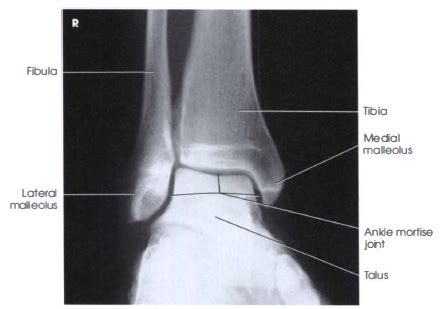 AP MORTISE PROJECTION - 15 TO 20 DEGREE MEDIAL ROTATION : ANKLE - RadTechOnDuty