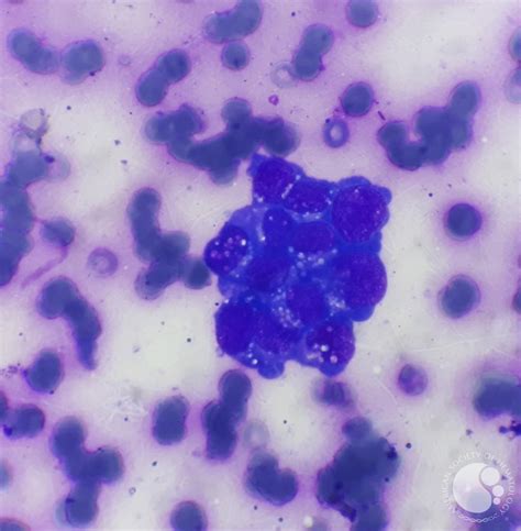 Hypocellular bone marrow with metastatic cells 2