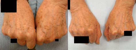 Brown Spot Removal – Fairfield Dermatology