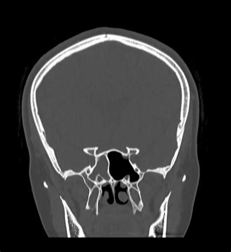 CT of paranasal sinuses, showing opacification of right sphenoid sinus ...