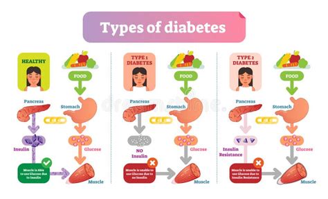 Diabetes Types Diagram