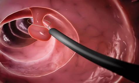 USMSTF Guidelines for follow-Up after Colonoscopy and Polypectomy in ...