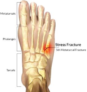 Foot Fracture Treatment Broward & Palm Beach | Florida Foot & Ankle