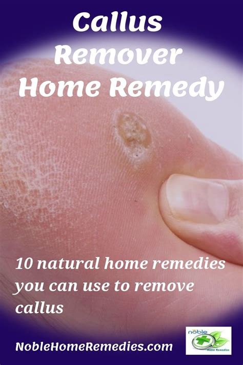 How to Get Rid of Calluses on Feet: 11 Best Remedies | Callus removal ...