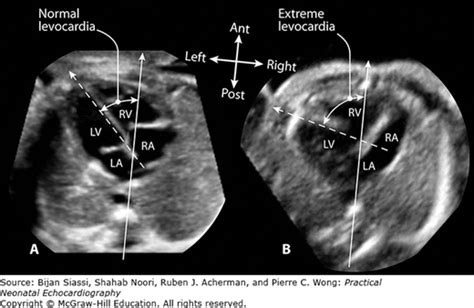 Overview of Fetal Echocardiography* | Thoracic Key