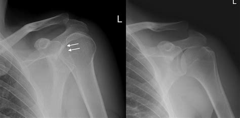 Posterior shoulder dislocation - Radiology at St. Vincent's University ...