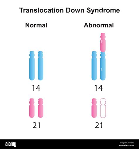 Translocation down syndrome hi-res stock photography and images - Alamy