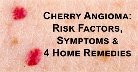 Cherry Angioma: Risk Factors, Symptoms & 4 Home Remedies - David ...