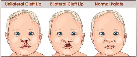 Cleft Palate: Causes, Treatment and Speech Therapy | Speech Blubs