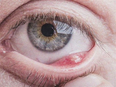 How Long Does A Stye Last? Duration And Treatment, 42% OFF