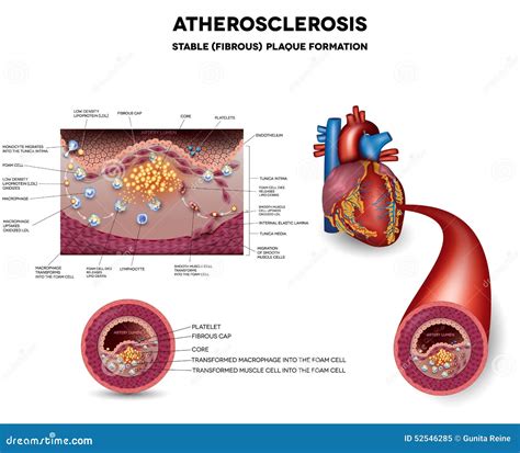 Coronary Arteries And Plaque Formation Cartoon Vector | CartoonDealer ...