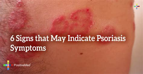 6 Signs that May Indicate Psoriasis Symptoms - PositiveMed