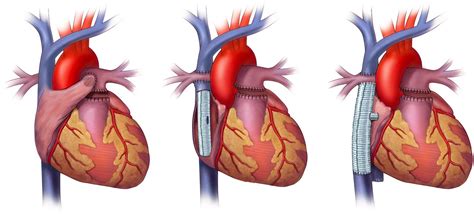 Role of imaging in the evaluation of single ventricle with the Fontan palliation | Heart