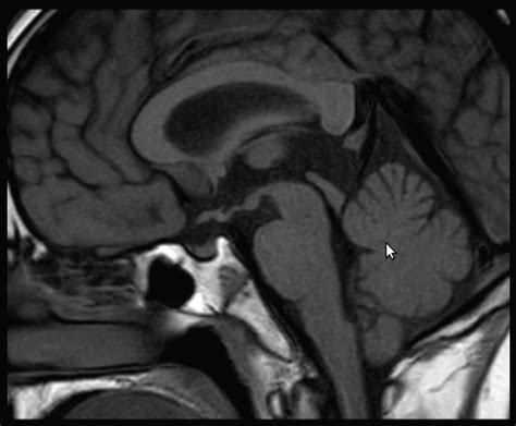 Late Discovery of Pituitary Stalk Interruption