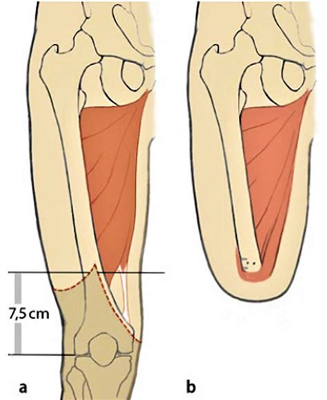 Amputation causes, types of amputation and amputation complications