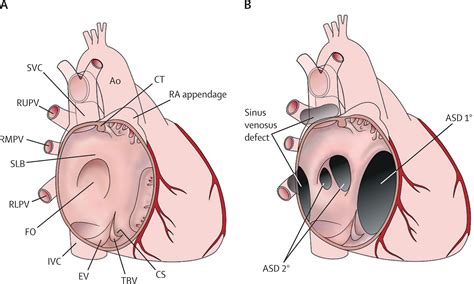 Atrial septal defects - The Lancet