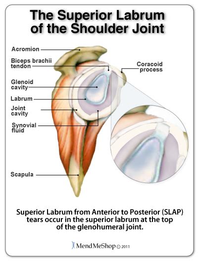 SLAP (Superior Labrum Anterior to Posterior) Tear