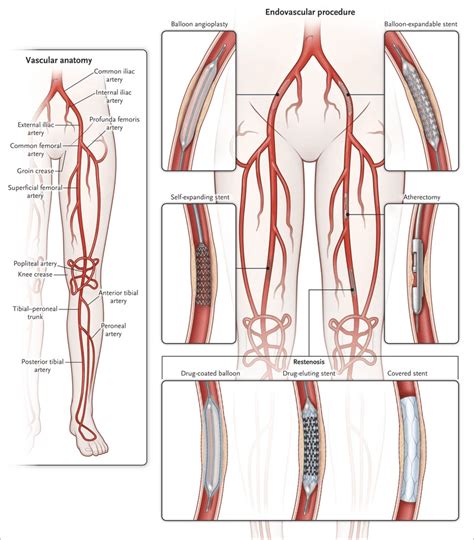 PAD Specialist - Center for Advanced Cardiac and Vascular Interventions