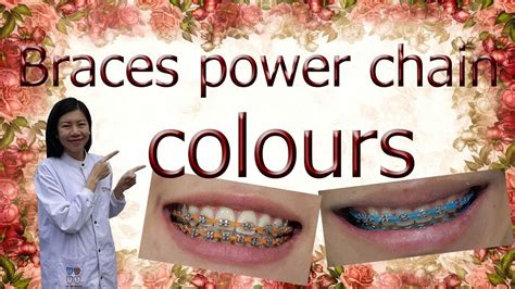 Braces power chain colors - YouTube