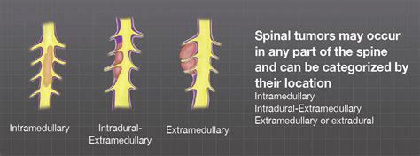 Spinal Tumors - Brainlab.org