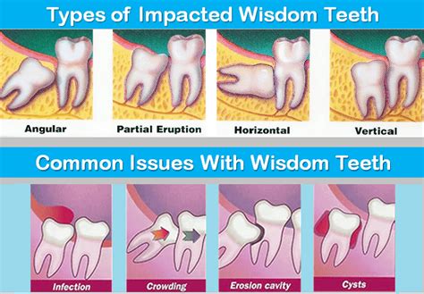 Tips to Speed up Recovery After Wisdom Teeth Removal | After wisdom ...