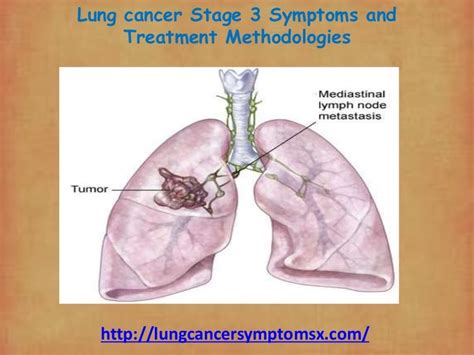 Lung cancer stage 3 symptoms and treatment methodologies