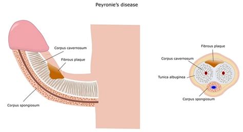 Peyronies Disease - Dr Anish Kumar Gupta