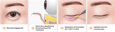 Eye Bag Removal Surgery For The Elderly: Is It Recommended? | Dream ...