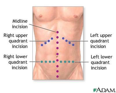 What Is an Exploratory Laparotomy Surgery?: Laparotomy Abdominal Surgery Abdominal Hernia ...