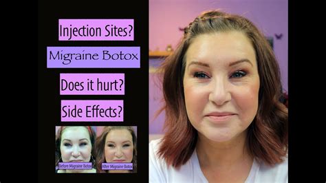 How Long For Botox To Work For Migraines / Botox Injections For Migraines Migraine Treatment ...