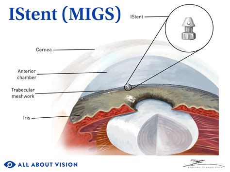 Trabecular Meshwork: Key Role in Eye Fluid Drainage