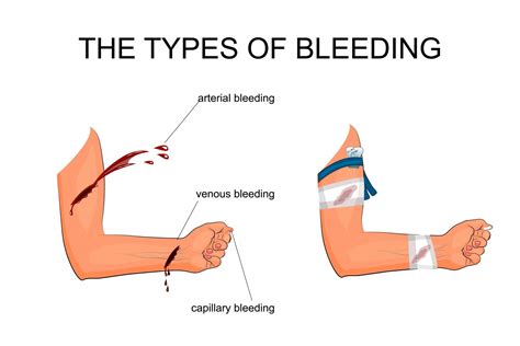 3 different types of bleeding and how to control them - UniFirst First ...