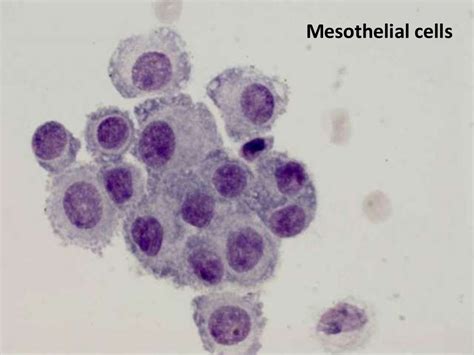 Fluid cytology in serous cavity effusions