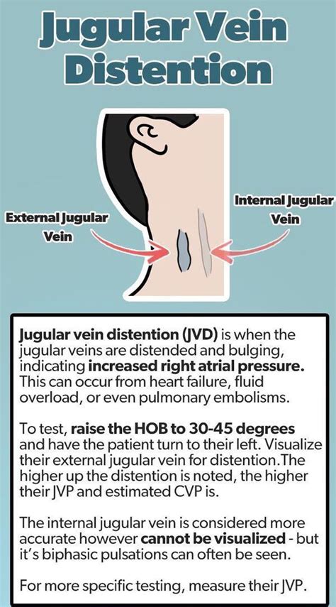 Jugular Vein Distention (JVD) - MEDizzy