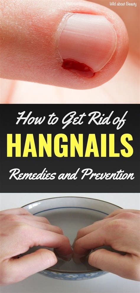 How to Get Rid of Hangnails – Remedies and Prevention | Warts, Warts on face, Hangnail treatment