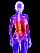 Diffuse idiopathic skeletal hyperostosis | Canada| PDF | PPT| Case Reports | Symptoms | Treatment