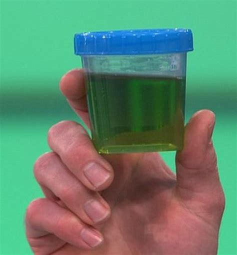 Green Urine - Symptoms, Causes, Treatment, Medication | HubPages