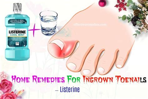 25 Effective Home Remedies For Ingrown Toenails In Adults & Kids