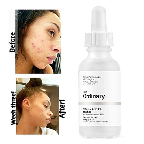 The Ordinary Salicylic Acid 2% Solution – Simply Glow