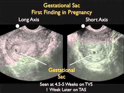 Intrauterine Pregnancy - Part 1 - SonoSite, Inc. - YouTube