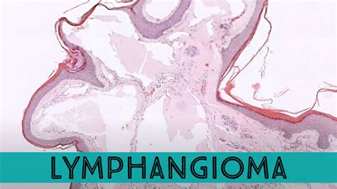 Lymphangioma (Lymphatic Malformation) short video | KiKo XP